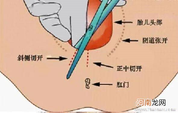 顺产第五天伤口更痛