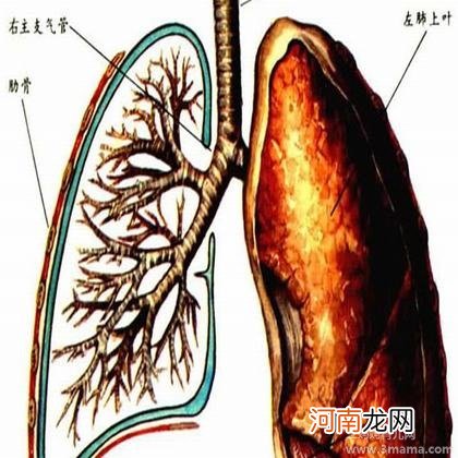 支气管炎的冬季预防保健