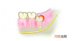 牙龈肿痛如何预防