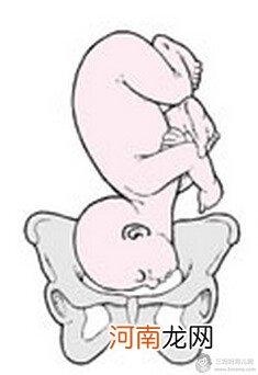 4种胎位不正导致难产