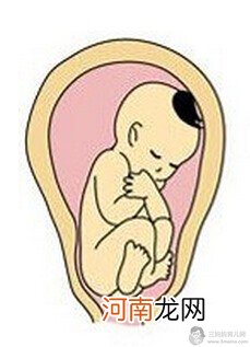 4种胎位不正导致难产