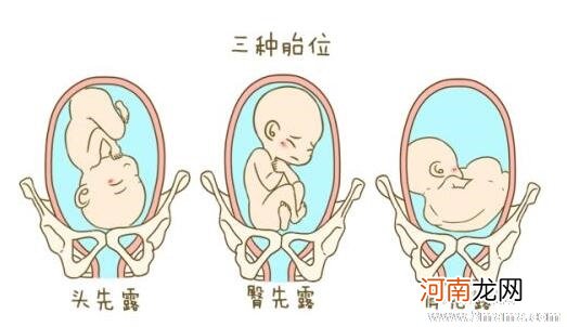 37周胎位不正能顺产吗