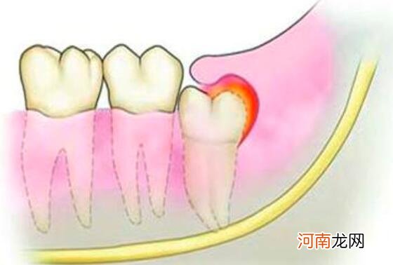 智齿发炎该怎么办