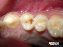 蛀牙能修复吗