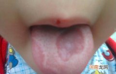 小孩舌头溃疡怎么办