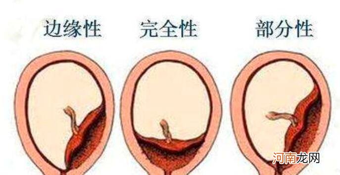 胎盘低如何护理