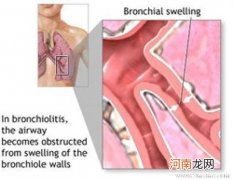 小儿支气管炎概述