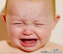 婴儿湿疹的常识会是什么呢