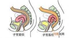 子宫移位是怎么回事