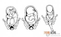 胎位不正有危害 胎位检查四步骤