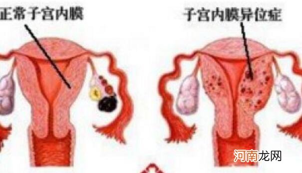 子宫移位该怎么办