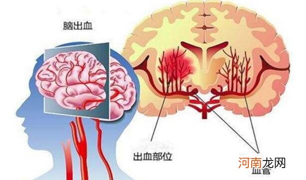 脑出血病人吃什么好