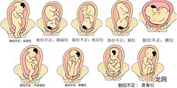 胎位不正发动了怎么办