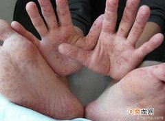 手足口病的初期症状是有哪些