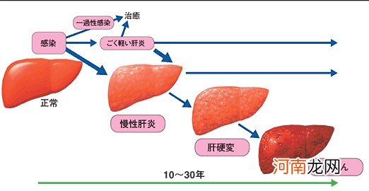 黄疸肝炎能活多久