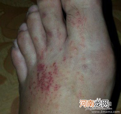 手足口病是湿疹吗