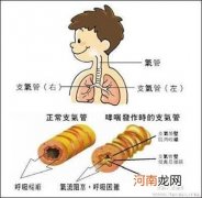 小儿支气管哮喘该怎么治疗