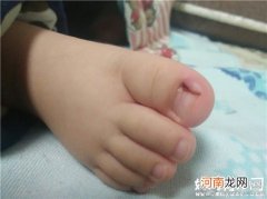 宝宝为什么会得甲沟炎 都是因为家长修剪趾甲犯了这些错