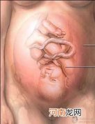 图片 剖腹产分娩过程 剖腹产的术全过程 - 剖腹产