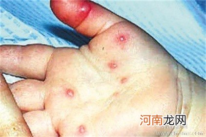 手足口病的治疗阶段和要点有哪些