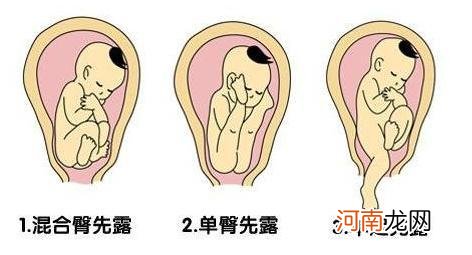 孕30周胎位不正怎么调整