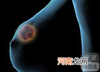 乳腺增生疼痛流黄水