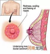 乳头疼痛挤出来有脓怎么回事