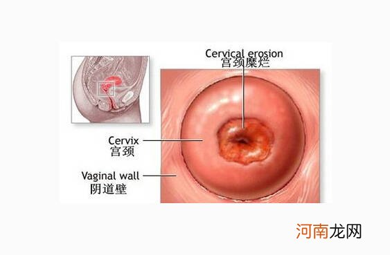 宫颈肥大同房有啥症状