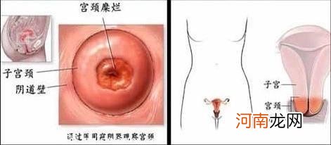 宫颈肥大同房有啥症状