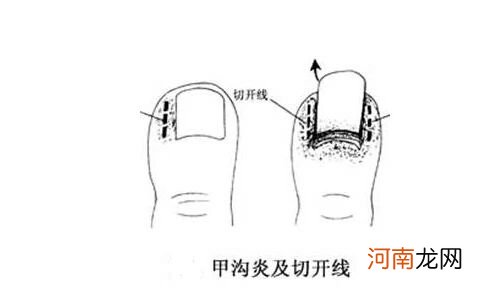 脚趾甲长到肉里