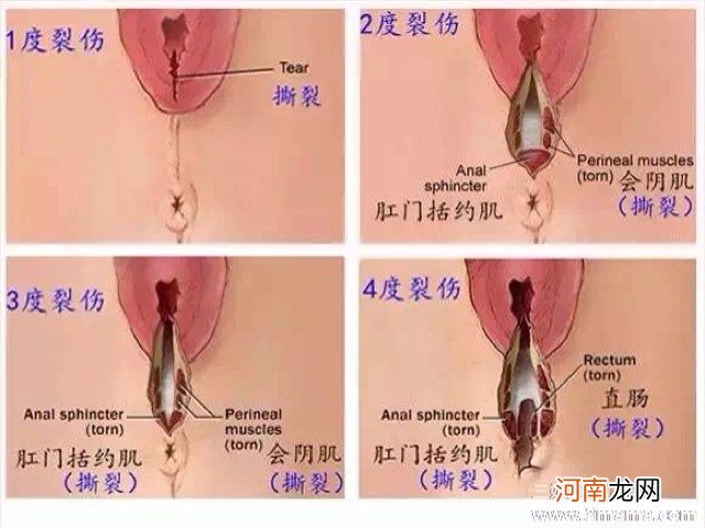 顺产时做会阴侧切真的有那么恐怖吗？ - 顺产