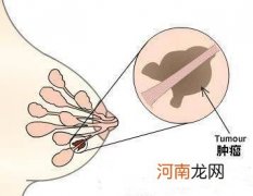 乳房溢血是乳腺癌晚期