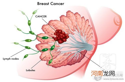 乳腺溢液10年怎么办