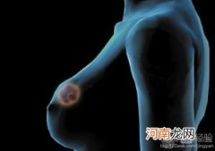 乳房溢乳需要检查什么