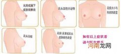 乳头溢液常见于什么病如何治疗