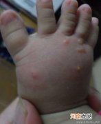 小儿手足口病的常见治疗方法