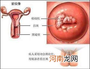 女性宫颈炎影响生育 需及早治疗