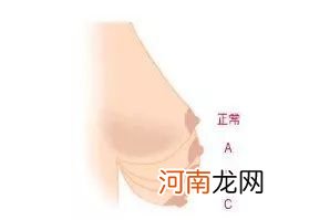 乳房松弛下垂怎样变紧致