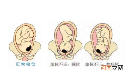 怀孕胎位不正影响大吗