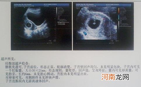 做好孕检及时发现胎停育