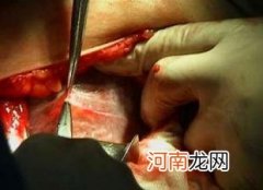 剖腹产手术前注意事项