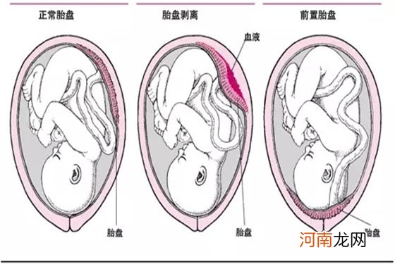 胎盘低置几个月最危险 十有八九你搞错了时间