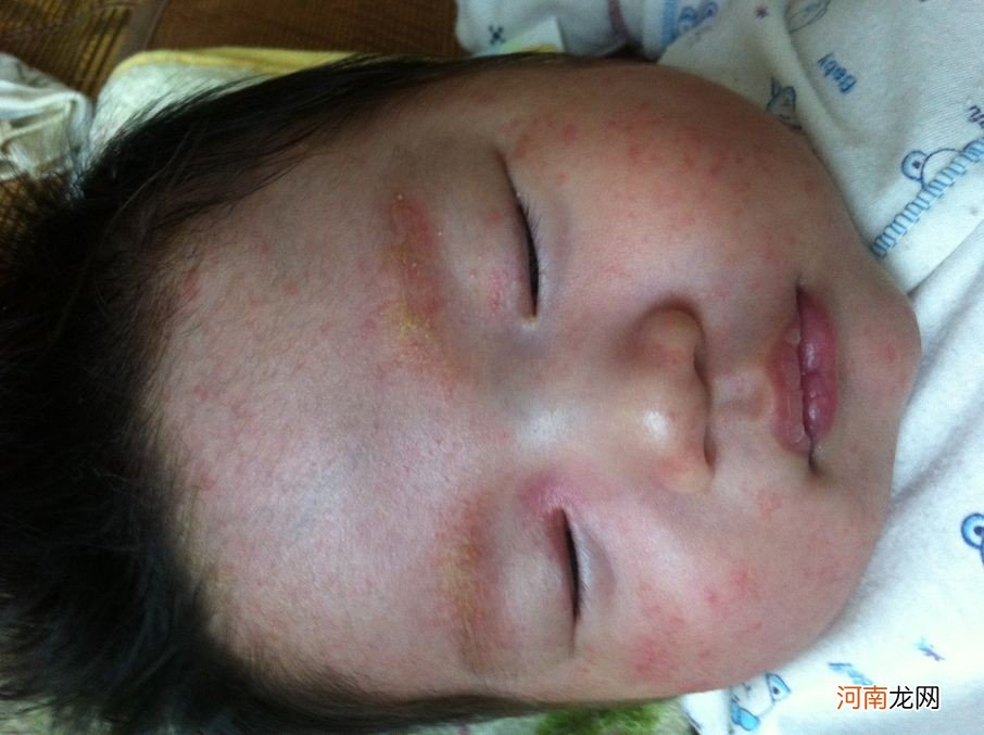 宝宝得了湿疹的要怎么样护理和治疗呢