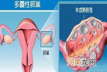 孕期如何预防多囊卵巢综合症