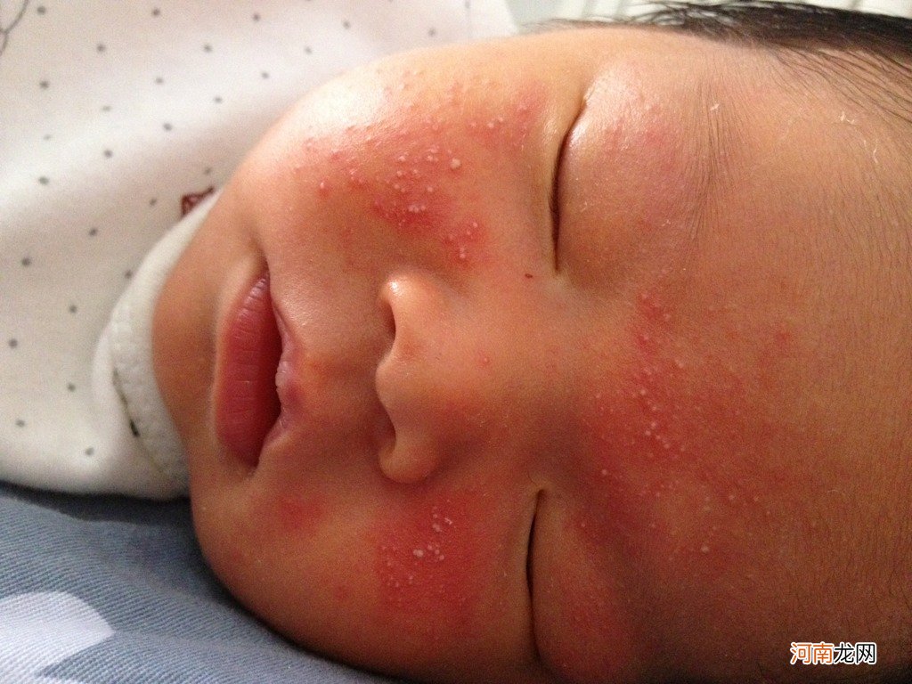 宝宝得了过敏性湿疹不能吃什么