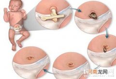 新生儿脐带护理三原则 步步为营的新生儿脐部护理巧