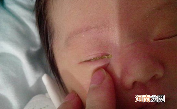 婴儿眼屎多勿急着用败火药