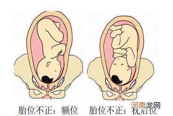 【胎位图】孕妇怎么摸胎位正不正 胎位不正怎么办