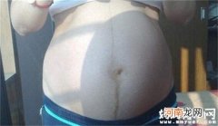 孕妇肚子上的黑线是什么 妊娠中线与妊娠纹是一样吗