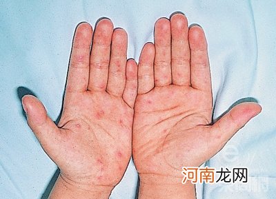 香港20名幼童感染手足口病